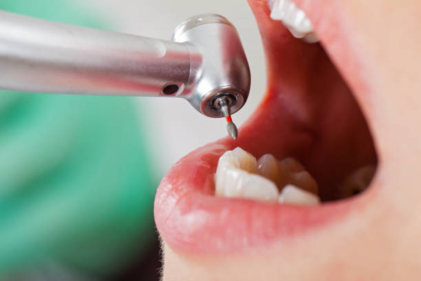 Best Root Canal Emergency Dentist  in Thermalito, CA